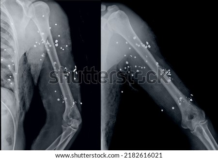 X-ray pellets and gunshot wounds to the arm