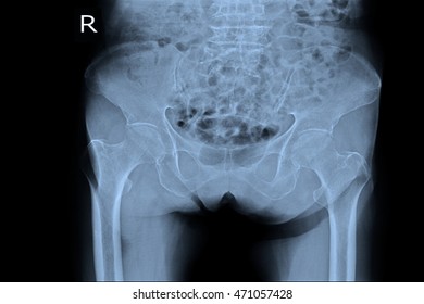 Xray Pelvic 