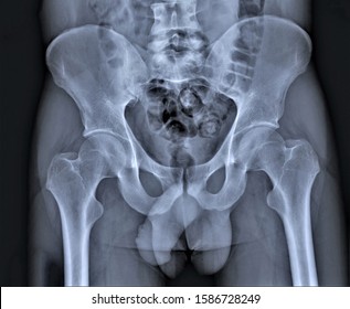 X-ray Of Pelvic Bones And Hip Joints In Direct Projection, Coxarthrosis, Osteoporosis, Medical Research