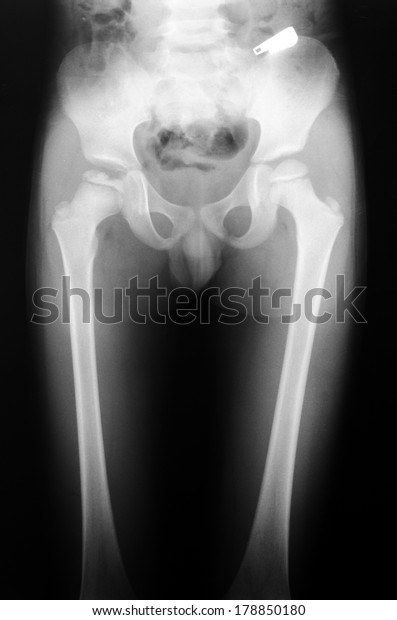 Xray Pelvic Boy 6 Years Old Stock Photo Edit Now 178850180