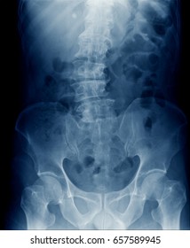 Xray Pelvic Spine Show Scoliosis Lumbar Stock Photo 657589945 ...