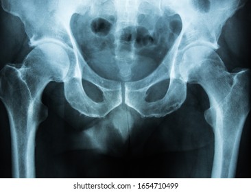 Xray Pelvis Stock Photo 1654710499 | Shutterstock