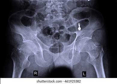 Xray Pelvis 