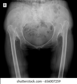 X-ray Pelvis: Congenital Dislocation Of Hip. 