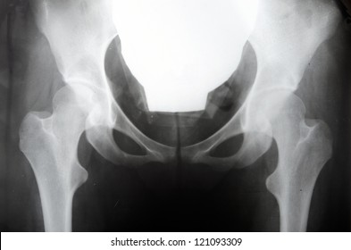 Xray Pelvis Displacement Bones Stock Photo 121093309 