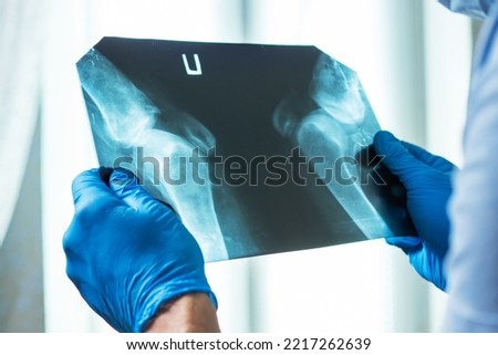X-ray of the pelvis of a man. Doctor hold in hands x-ray film