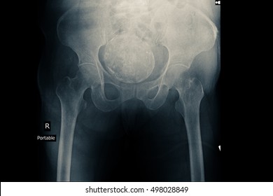 ovarian cancer on x ray)