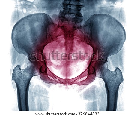 X-ray of the pelvis and spinal column