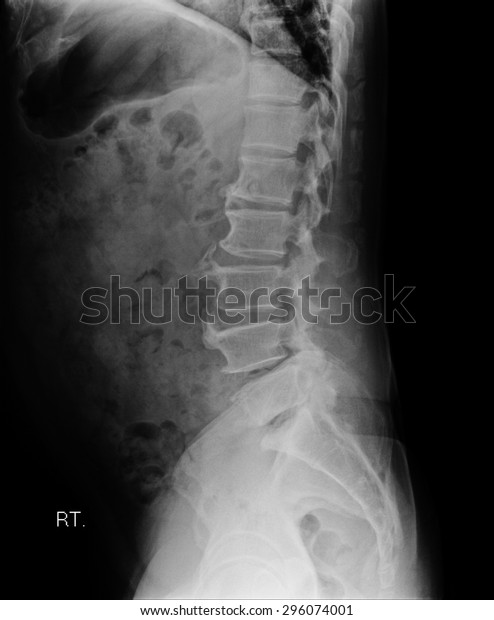 Xray Pelvis Spinal Column Stock Photo (Edit Now) 296074001