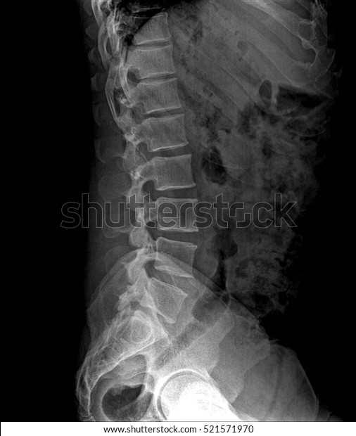 Xray Pelvis Spinal Column Side View Stock Photo (Edit Now) 521571970