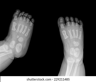 x-ray photo of baby feets