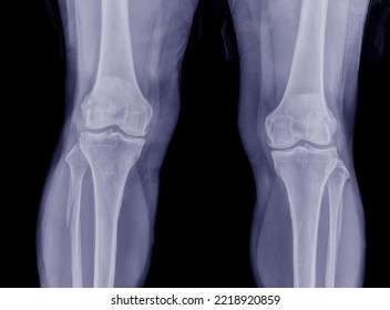 
X-ray Photo Both Knees Showed A Fracture Of The Fibula Bone.