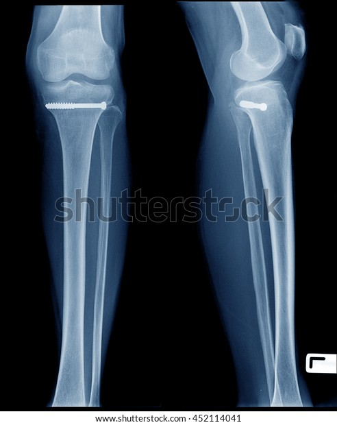 xray of broken knee