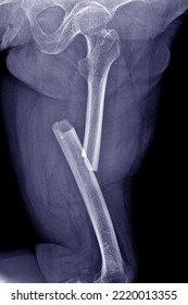 X-ray Photo Femur Fracture Of An Elderly Woman Caused By A Slipping Accident Inside The House