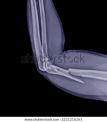 
x-ray photo The humerus has a fracture in the distal area.