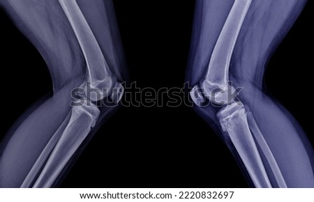 X-ray photo The knee and tibia have fractures around the tibia head.