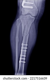 X-ray Photo The Leg Found A Fracture Of The Tibia Bone