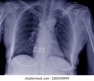 X-ray Photo Of A Woman With A Foreign Body