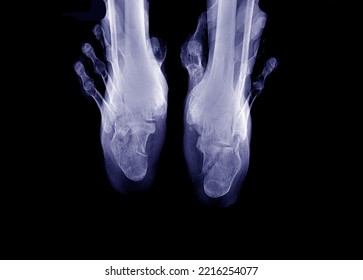 X-ray photograph of both heels in posture
axial view - Shutterstock ID 2216254077