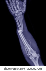 Xray Photograph Fracture Both Bone Forearm Stock Photo 2200027205 ...