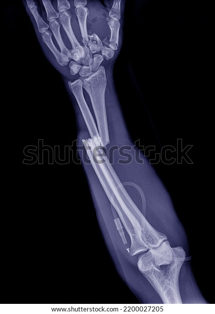 X-ray photograph of the fracture both bone of\
the forearm at the\
accident