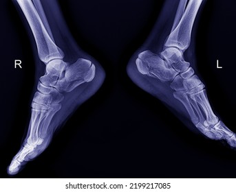 X-ray photograph of the heel side of the accident falling from a height - Shutterstock ID 2199217085