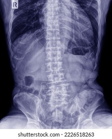 X-ray photograph of the spine in the Uplai position. - Shutterstock ID 2226518263