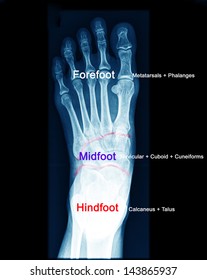 Xray Picture Foot Stock Photo 143865937 | Shutterstock