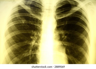 Xray Picture Human Thorax Stock Photo 2889069 | Shutterstock