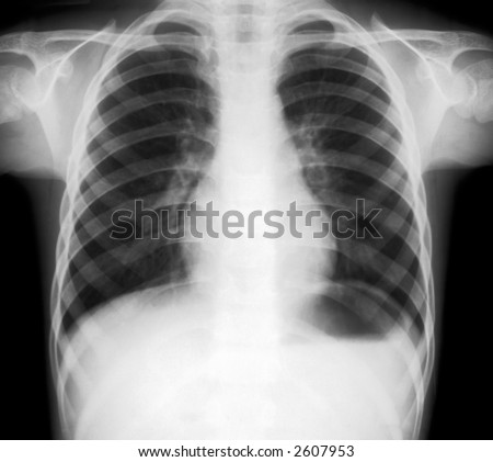X-ray picture of human torax