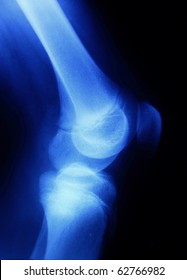 X-ray picture showing knee joints