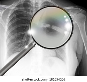 X-ray Picture Showing Rib Joints With Broken