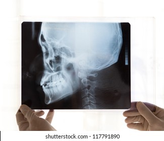 X-ray picture of the skull in doctor's hand.