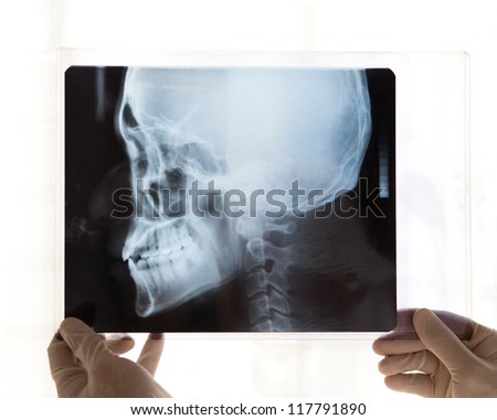 X-ray picture of the skull in doctor's hand.