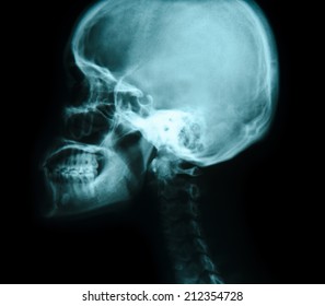 mouth and skull x ray of peek a poo