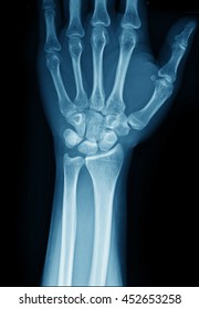 Wrist X Ray Anatomy Radiology Radiographic Stock Photo 1459924334 ...