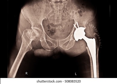 Xray Post Operation Total Hip Arthroplasty