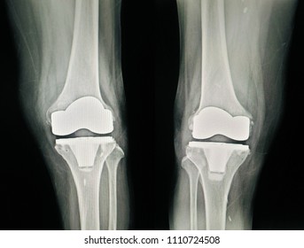 Oa Knee Cemented Tkr Left Knee Stock Photo (Edit Now) 423089386