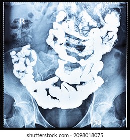 X-ray radiogram with Barium study of small bowel after 150 minutes (two and half hours) after the start of passage procedure