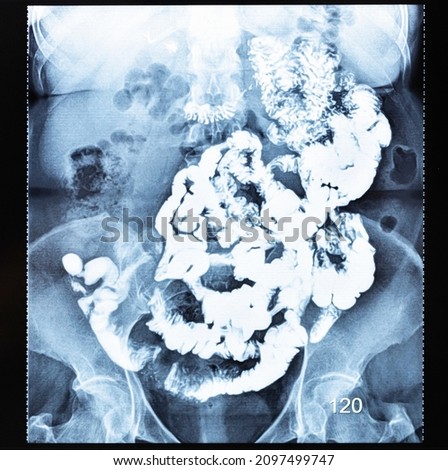 X-ray radiogram with Barium study of small bowel after 120 minutes (two hours) after the start of passage procedure