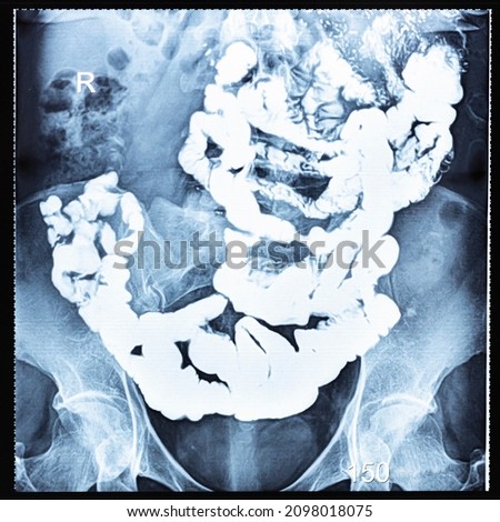 X-ray radiogram with Barium study of small bowel after 150 minutes (two and half hours) after the start of passage procedure