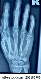 Xray Radiograph Of Right Hand Sustaining 5th Metacarpal Bone Fracture ( Boxers Fracture) . “R” Indicates Right Side Of Hand