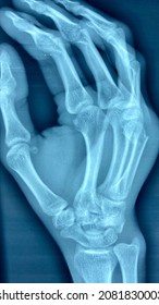 Xray Radiograph Of Right Hand Sustaining 5th Metacarpal Bone Fracture ( Boxers Fracture) . “R” Indicates Right Side Of Hand