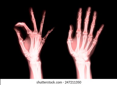 X-ray red fingers to check for irregularities in the motion of the fingers are not.