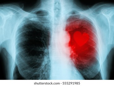 X-ray Red Heart Of Human (heart Disease)