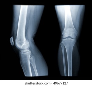 x-ray of a regular knee joint isolated ob black background