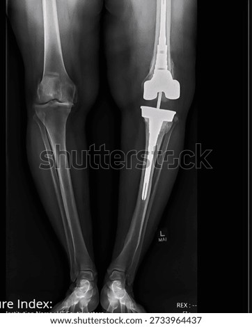 xray of a revised knee replacement with broken joint hardware