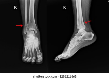 X-ray Right Ankle A female 64 year old accident showing Spiral fracture of distal fibula at level of syndesmosis, with minimal displacement on red arrow mark.Medical image concept.