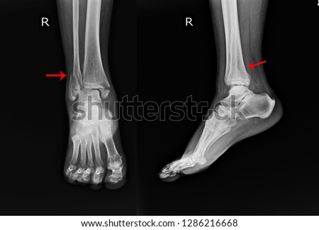 X-ray Right Ankle A female 64 year old accident showing Spiral fracture of distal fibula at level of syndesmosis, with minimal displacement on red arrow mark.Medical image concept.