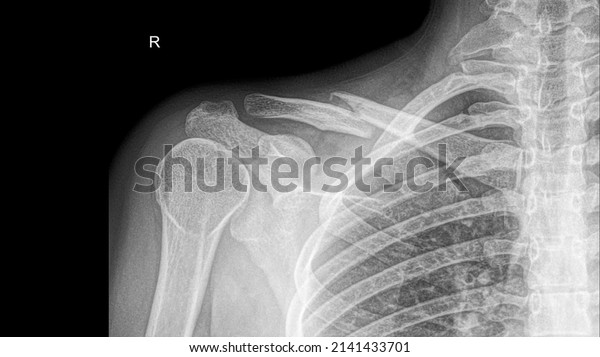 X-ray of a right  clavicle fracture with\
displacement of bones\
fragments.